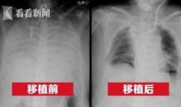 港媒最新爆料新冠肺病人,新冠肺病患者真实生活与康复历程”